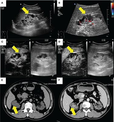 Case Report: The ultrasound features of acquired cystic disease-associated renal cell carcinoma: a case series
